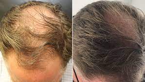 exosomes-for-hair-loss.jpg