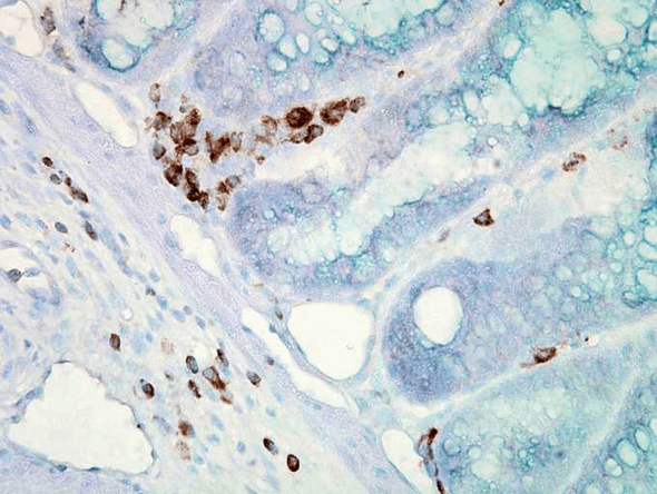 Immunohistochemistry analysis using Mouse Anti-Hsp70 Monoclonal Antibody, Clone C92F3A-5 (STMA00001). Tissue: colon carcinoma. Species: Mouse. Fixation: Formalin. Primary Antibody: Mouse Anti-Hsp70 Monoclonal Antibody (STMA00001) at 1:10000 for 12 hours at 4°C. Secondary Antibody: Biotin Goat Anti-Mouse at 1:2000 for 1 hour at RT. Counterstain: Mayer Hematoxylin (purple/blue) nuclear stain at 200 µl for 2 minutes at RT.