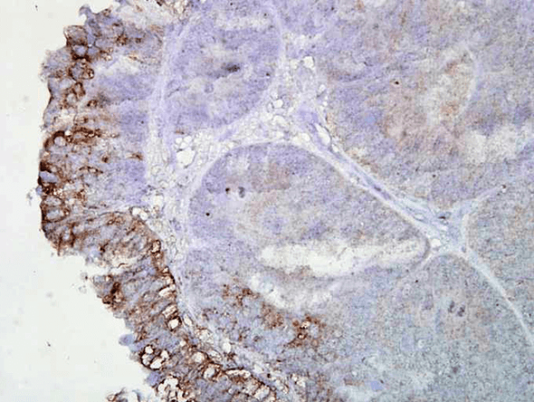 Immunohistochemistry analysis using Mouse Anti-Hsp90 Monoclonal Antibody, Clone AC-16 (STMA00009). Tissue: colon carcinoma. Species: Human. Fixation: Formalin. Primary Antibody: Mouse Anti-Hsp90 Monoclonal Antibody (STMA00009) at 1:2000 for 12 hours at 4°C. Secondary Antibody: Biotin Goat Anti-Mouse at 1:2000 for 1 hour at RT. Counterstain: Mayer Hematoxylin (purple/blue) nuclear stain at 200 µl for 2 minutes at RT.