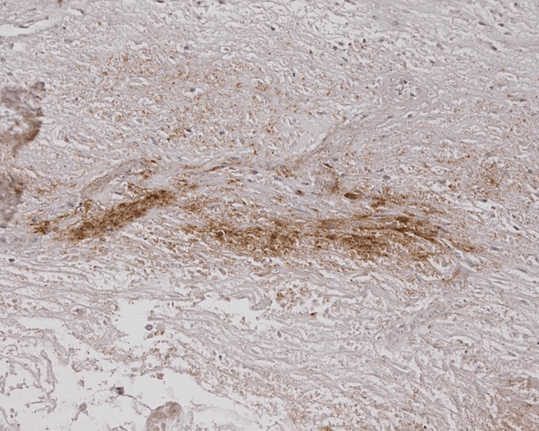 Immunohistochemistry analysis using Mouse Anti-Alginate Monoclonal Antibody, Clone 4B10-1C5 (STMA00060). Tissue: Burned Skin. Species: Human. Primary Antibody: Mouse Anti-Alginate Monoclonal Antibody (STMA00060) at 1:200.