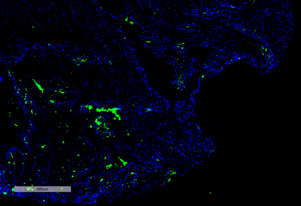 Immunohistochemistry analysis using Mouse Anti-Citrulline Monoclonal Antibody, Clone 2D3.1 (STMA00173). Tissue: Thyroid Cancer. Species: Human. Primary Antibody: Mouse Anti-Citrulline Monoclonal Antibody (STMA00173) at 1:100 for Overnight at 4C, then 30 min at 37C. Secondary Antibody: Goat Anti-Mouse IgG (H+L): FITC for 45 min at 37C. Counterstain: DAPI for 3 min at RT. Magnification: 5X.