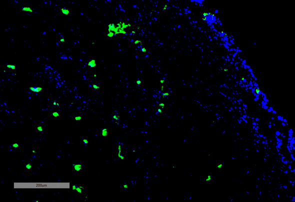 Immunohistochemistry analysis using Mouse Anti-Acrolein Monoclonal Antibody, Clone 10A10 (STMA00178). Tissue: Adrenal Carcinoma. Species: Human. Primary Antibody: Mouse Anti-Acrolein Monoclonal Antibody (STMA00178) at 1:100 for Overnight at 4C, then 30 min at 37C. Secondary Antibody: Goat Anti-Mouse IgG (H+L): FITC for 45 min at 37C. Counterstain: DAPI for 3 min at RT. Magnification: 5X.