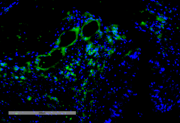 Immunohistochemistry analysis using Mouse Anti-VPS35 Monoclonal Antibody, Clone 11H10 (STMA00212). Tissue: Intestinal Cancer. Species: Human. Primary Antibody: Mouse Anti-VPS35 Monoclonal Antibody (STMA00212) at 1:100 for Overnight at 4C, then 30 min at 37C. Secondary Antibody: Goat Anti-Mouse IgG (H+L): FITC for 45 min at 37C. Counterstain: DAPI for 3 min at RT. Magnification: 20X.