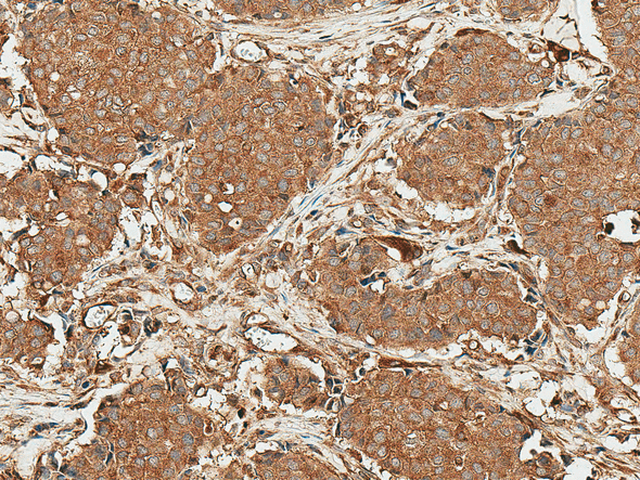 Immunohistochemistry analysis using Rabbit Anti-ROR1 Polyclonal Antibody (STPA00081). Tissue: Breast Cancer. Species: Human. Fixation: Formalin Fixed Paraffin-Embedded. Primary Antibody: Rabbit Anti-ROR1 Polyclonal Antibody (STPA00081) at 1:50 for 30 min at RT. Counterstain: Hematoxylin. Magnification: 20X. HRP-DAB Detection.