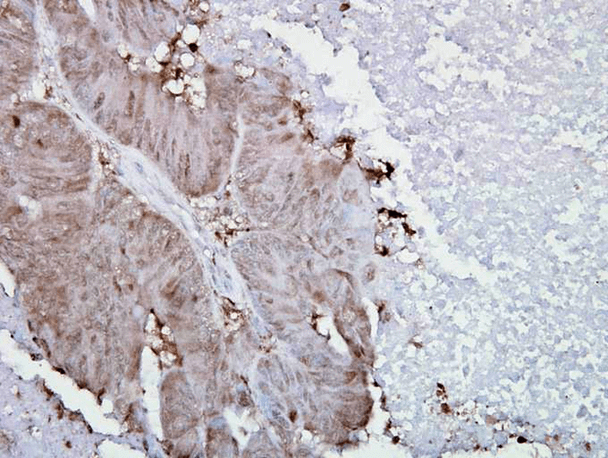Immunohistochemistry analysis using Mouse Anti-Hsp90 alpha Monoclonal Antibody, Clone K41009 (STMA00006). Tissue: colon carcinoma. Species: Human. Fixation: Formalin. Primary Antibody: Mouse Anti-Hsp90 alpha Monoclonal Antibody (STMA00006) at 1:5000 for 12 hours at 4°C. Secondary Antibody: Biotin Goat Anti-Mouse at 1:2000 for 1 hour at RT. Counterstain: Mayer Hematoxylin (purple/blue) nuclear stain at 200 µl for 2 minutes at RT.