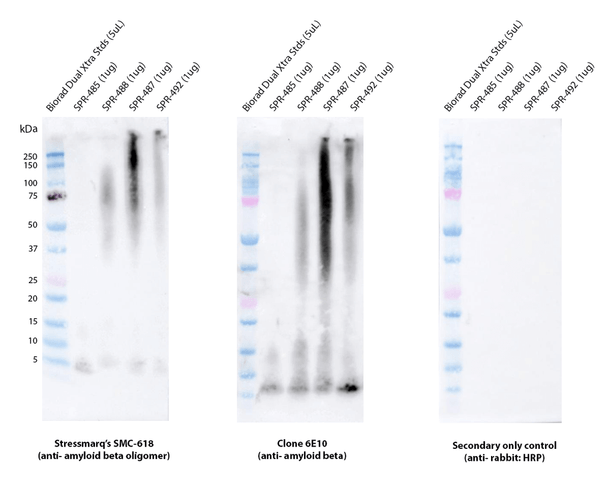 Immunohistochemistry (IHC) analysis on a temporal lobe section of a human Alzheimer’s diseased brain tissue. Block: 3% skim milk in PBST. Primary Antibody: Rabbit Anti-Amyloid Beta Oligomer Monoclonal Antibody, clone 1A2 (STMA00222) at 1:100. Secondary: Goat-anti-rabbit IgG:HRP at 1:100. Stained with DAB (1:50) and Hematoxylin (1:10).