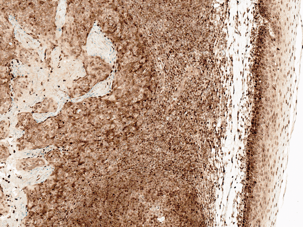 Immunohistochemistry analysis using Rabbit Anti-CCR2 Polyclonal Antibody (STPA00073). Tissue: Tonsil. Species: Human. Fixation: Formalin Fixed Paraffin-Embedded. Primary Antibody: Rabbit Anti-CCR2 Polyclonal Antibody (STPA00073) at 1:50 for 30 min at RT. Counterstain: Hematoxylin. Magnification: 10X. HRP-DAB Detection.