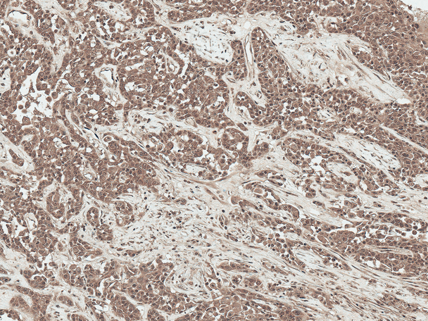 Immunohistochemistry analysis using Rabbit Anti-SFRP2 Polyclonal Antibody (STPA00085). Tissue: Liver. Species: Human. Fixation: Formalin Fixed Paraffin-Embedded. Primary Antibody: Rabbit Anti-SFRP2 Polyclonal Antibody (STPA00085) at 1:50 for 30 min at RT. Counterstain: Hematoxylin. Magnification: 20X. HRP-DAB Detection.