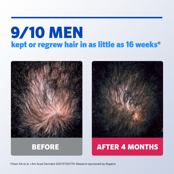 Regaine Men’s Extra Strength 5% Minoxidil Topical Solution – Hair Regrowth Treatment for Men (1 Month Supply, 60mL)