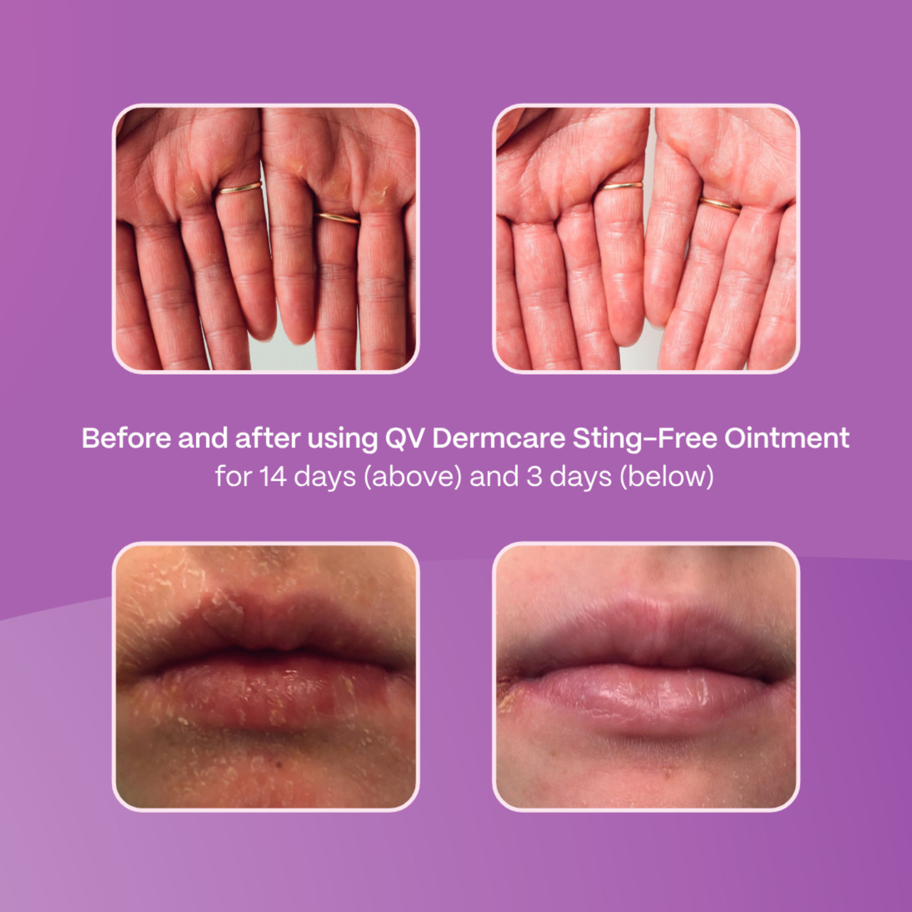 Ego QV Dermcare Sting-Free Ointment 200g