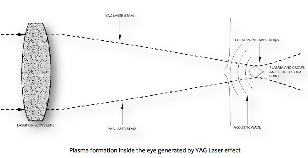 yag laser eye