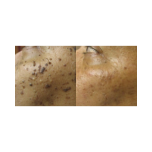 Pigmented lesion treatment before and after