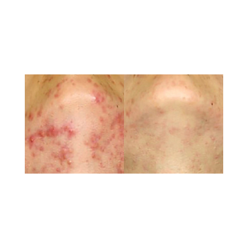 Rosacea treatment before and after