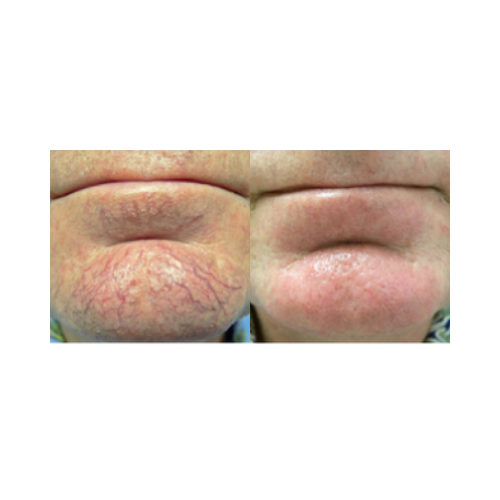 Telangiectasia treatment before and after