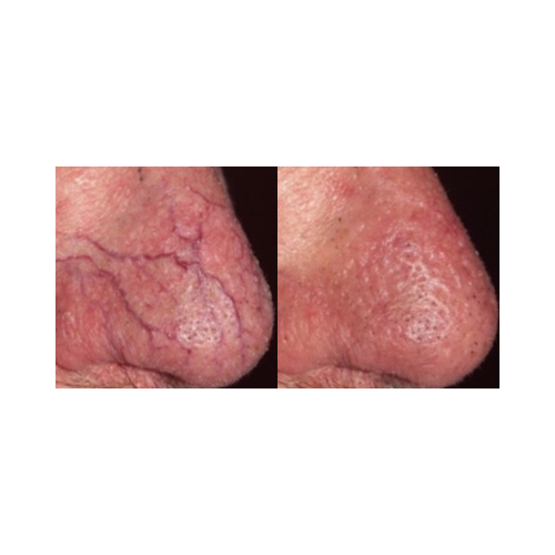 Nasal telangiectasia treatment before and after