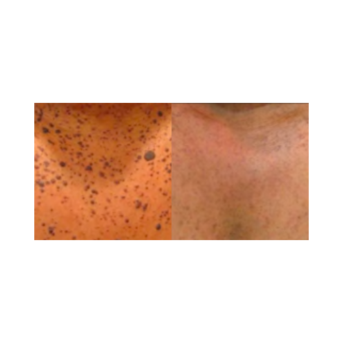 Solar lentigines treatment before and after