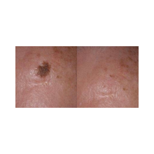 Café-au-lait macule treatment before and after