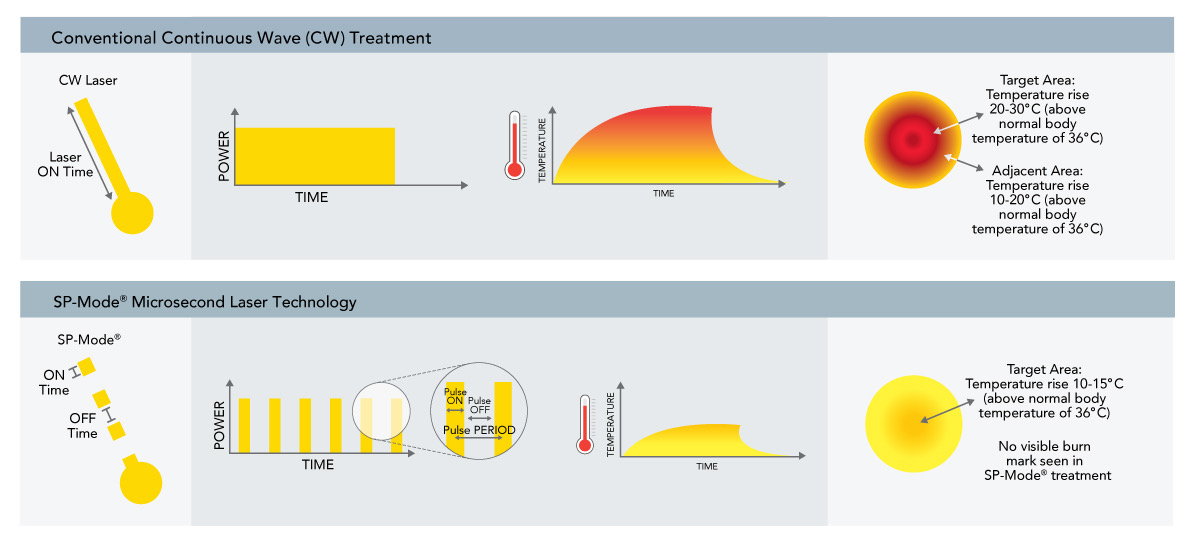 Diagram comparing Conventional Continuous Wave (CW) treatment versus SP-Mode® Microsecond Laser Technology, showing reduced temperature rise and no visible burn marks
