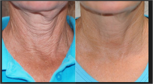 Non-Surgical Neck Lift With Fotona