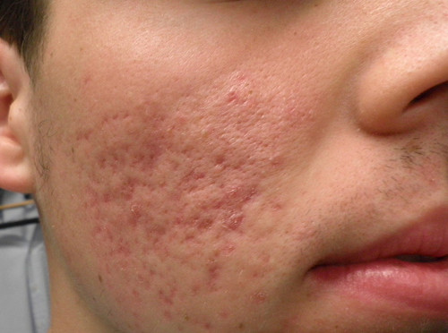 Active Acne and Acne Scars