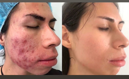 Active Acne and Acne Scars