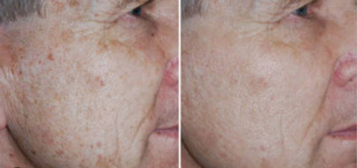 Deep Micro Peel