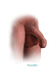 Healthy Foreskin for Men  - Treating Phimosis and Other Foreskin Problems