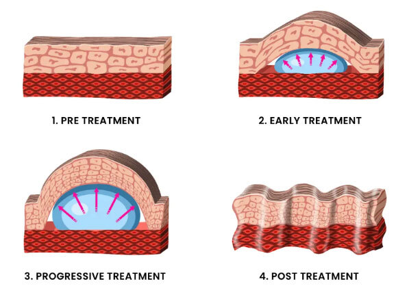 How does the foreskin stretch?
