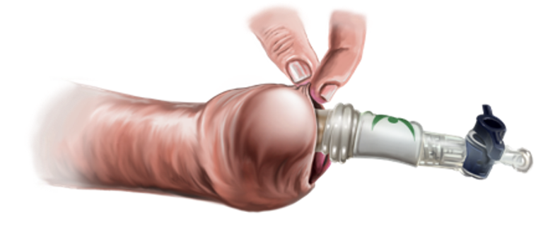 Non-surgical Balloon Foreskin Stretching: A Cost-effective and