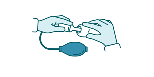 Step 1 – Place balloon under foreskin