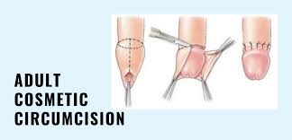 Image result for adult circumcision