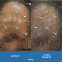 Hair Regrowth Stimulation Kit For Men| Spectral.Uhp + Revita Shampoo