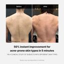 Medicube Red Acne Body Wash 14.52 Fl.Oz I Low Ph And Hydrating Cleanser With Salicylic Acid, Lactic Acid, Niacinamide And Hyaluronic Acid Suitable For Bacne Treatment | Korean Skin Care