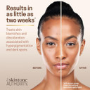 Ambi Even And Clear Foaming Cleanser, Salicylic Acid Acne Treatment, Clears And Helps Prevent New Acne Breakouts, Helps Visibly Improve Skin Tone And Texture, 6 Fl Oz