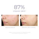 Derma E Anti-Acne Deep Cleansing Acne Pads, 50 Exfoliating Face Wipes With Azelaic Acid, Salicylic Acid & Chamomile, Acne Treatment For Face & Body, Helps Fight Breakouts & Blemishes