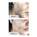 Nxn Acne Scar Treatment Gel With Antioxidants, Glycerin & Allantoin To Rapidly & Effectively Reduce Blemishes & Improve Scar Texture & Color - For Face/Body