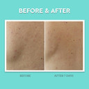 Bliss Clear Genius Body Acne Spray - 3.5 Fl Oz - Maximum Strength 2% Salicylic Acid & Niacinamide - Targets Body Acne & Prevents Future Breakouts - Post Workout - Clean - Vegan & Cruelty-Free