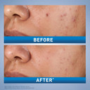 Cerave Salicylic Acid Acne Treatment With Glycolic Acid And Lactic Acid | Aha/Bha Acne Gel For Face To Control And Clear Breakouts |1.35 Ounce Cerave Salicylic Acid Acne Treatment With Glycolic Acid And Lactic Acid | Aha/Bha Acne Gel For Face To Control And Clear Breakouts |1.35 Ounce