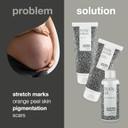 Tea Tree Oil Set for Scar & Stretch Mark Reduction | Vegan, Dermatologically Tested | Contains Body Scrub (200ml), Oil (150ml), Lotion (200ml)