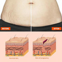 Stretch-Marks, Scar Treatment Oil - Boosts Collagen for Skin Lifting - Improves Treat of Scars, Stretch-Marks & Uneven Skin Tone - 125ml Stretch-Marks, Scar Treatment Oil - Boosts Collagen for Skin Lifting - Improves Treat of Scars, Stretch-Marks & Uneven Skin Tone - 125ml