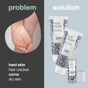 Corns & Calluses Kit with Tea Tree Oil for Soft Feet - Foot Cream, Heel Repair & Corn Stick Set for Effective Foot Care & Repair - Natural Ingredients - Perfect for Dry, Rough & Cracked Feet
