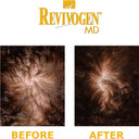 REVIVOGEN MD Scalp Therapy. Natural Hair Loss Solution for Fine & Thinning Hair