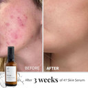 47 Skin Anti-blemish & scar repair Serum enriched with Silver Chitoderm for All Skin Types, Clear Skin Moisturiser, 50ml