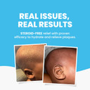 Grahams Natural Baby Eczema Body and Bath Oil - Clinically Proven Baby Oil for Cradle Cap Treatment & Baby Eczema - With Sunflower, Avocado & Jojoba Oil | For Ages 0 Months to 12 Years (100ml)