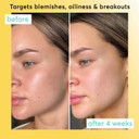 Super Facialist Pore Clarity Daily Exfoliator - Acne Treatment & Blackhead Remover Exfoliator with 1% Niacinamide, Tea Tree Oil & Prebiotics, Vegan Friendly 150ml