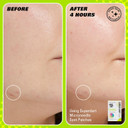 Revolution Skin, Spot, Dot, Go! Salicylic Acid Spot Patches, Discreet Pimple Patches With Salicylic Acid & Tea Tree, Vegan & Cruelty-Free, 60 Patches Per Box