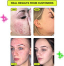 Carbon Theory Supacylic Hypa Dart Microdart Pimple Patch - 9 x Clear Pimple Patches - Micro Dart Pimple Patches - Spot Patches Microdart - Vegan Spot Treatment