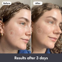 Hero Cosmetics Rescue Balm Post-Blemish Recovery Cream, Nourishing and Hydrating Moisturiser for Acne Prone Skin to Improve Skin Look, Dermatologist-Tested, Suitable for Sensitive Skin, 15 ml