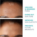 FOREO KIWI Whitehead & Blackhead Remover Tool, Facial Blackhead Remover Vacuum for Face & Nose, Pore Remover & Pimple Popper, Quick & Effective Device with Anti-Blemish Light