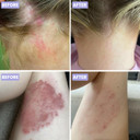 Grahams Natural Moisturising Psoriasis Cream - Clinically Proven Psoriasis Treatment for Scale, Dry Skin & Itchiness on Skin, Face & Scalp - With Calendula, Manuka Honey & Urea | Steroid-Free (75g)